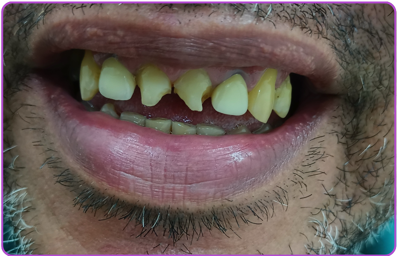 Antes